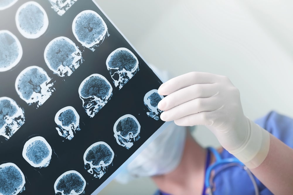 Indianapolis, IN Brain Injury Lawyer FAQs